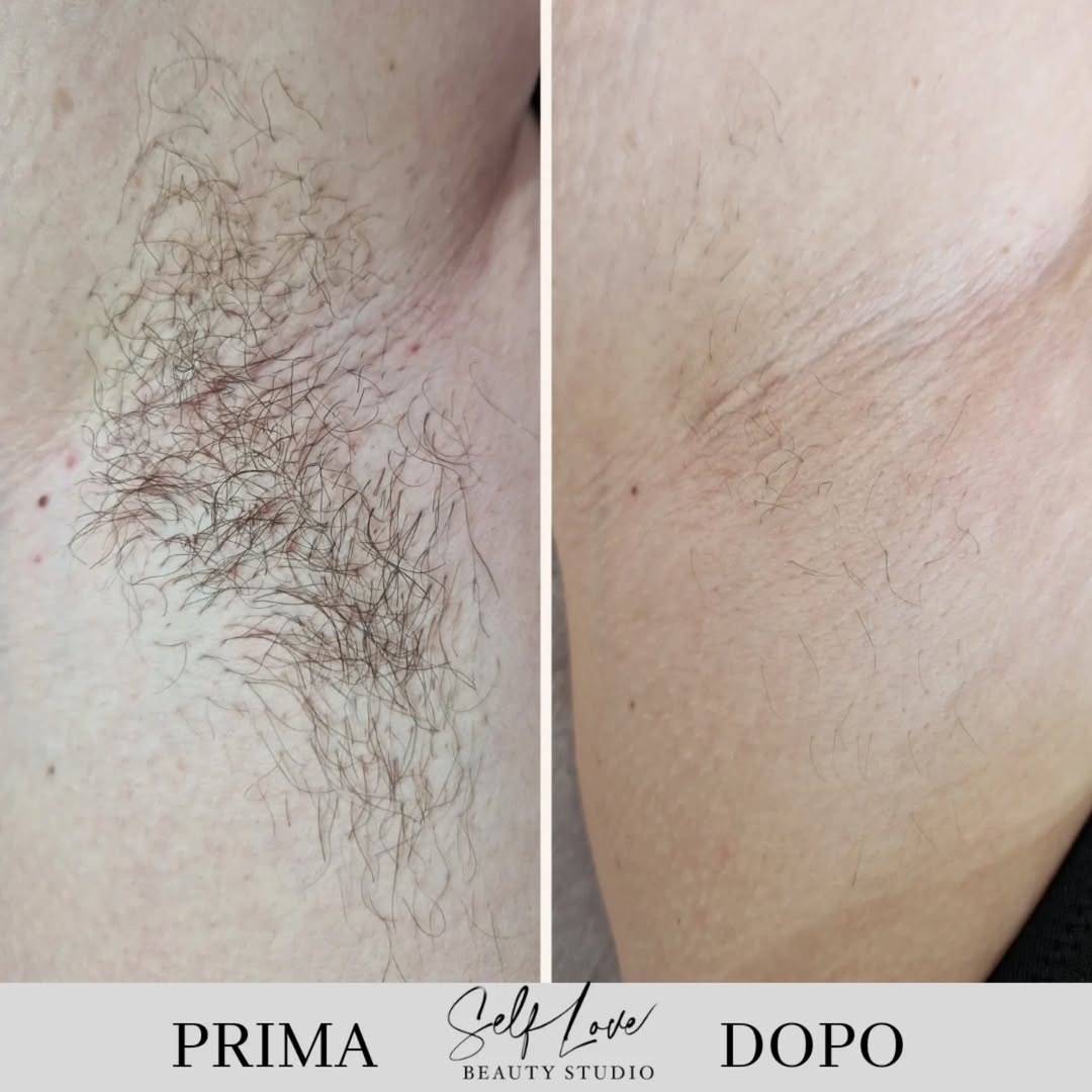 5066epilaszione-laser.jpg